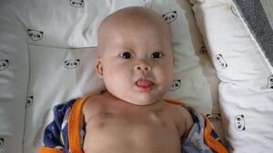 Kisah Chiara: Bayi 8 Bulan Berjuang Melawan Tumor Ganas dan Kelainan Bawaan