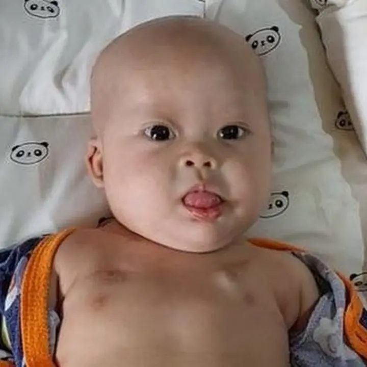 Kisah Chiara: Bayi 8 Bulan Berjuang Melawan Tumor Ganas dan Kelainan Bawaan