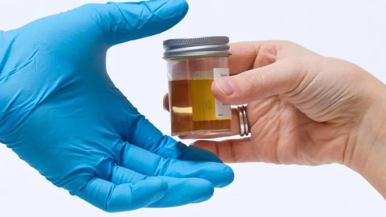 Foto Ilustrasi Tes Urine: (thinkstock)