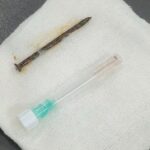 Pria 52 Tahun di Riau Tersedak Paku 5 cm Saat Perbaiki Kamar, Nyangkut di Paru-paru