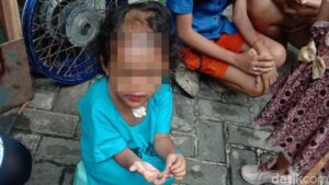 Pilu Nasib Balita Dianiaya dan Dibotaki Paman-Bibi di Surabaya