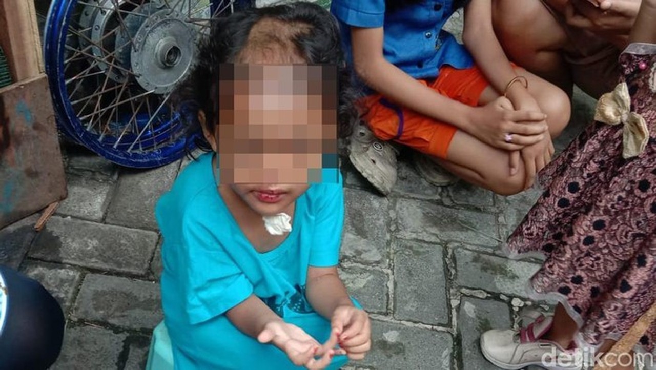 Pilu Nasib Balita Dianiaya dan Dibotaki Paman-Bibi di Surabaya