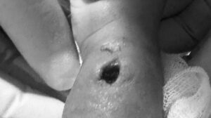 Bayi di Makassar Diduga Malpraktik, Tangan Berlubang Usai Diinfus, RS Buka Suara